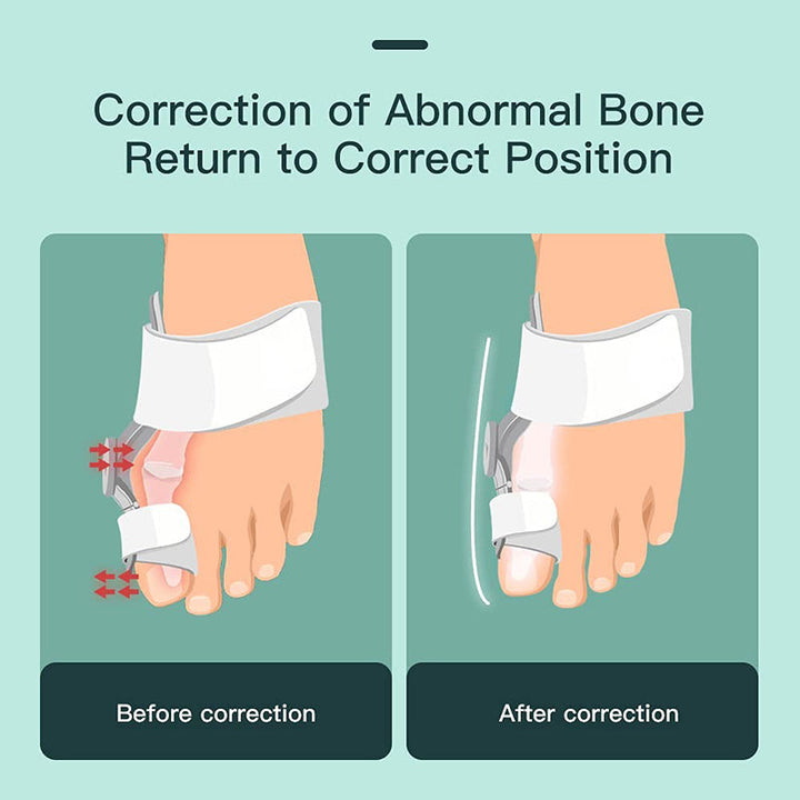 Upgraded Toe Bunion Corrector - 3D Knob Toes Corrector - FOFOPO