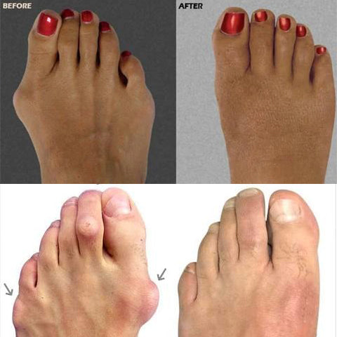 Upgraded Toe Bunion Corrector - 3D Knob Toes Corrector - FOFOPO