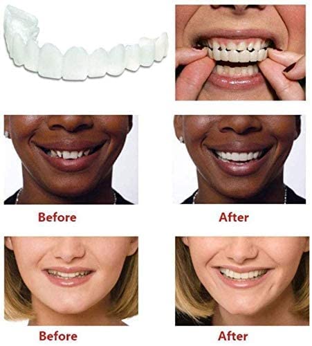 Snap on Smile Veneers - FOFOPO