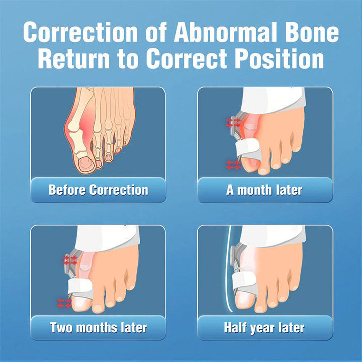 Upgraded Toe Bunion Corrector - 3D Knob Toes Corrector - FOFOPO