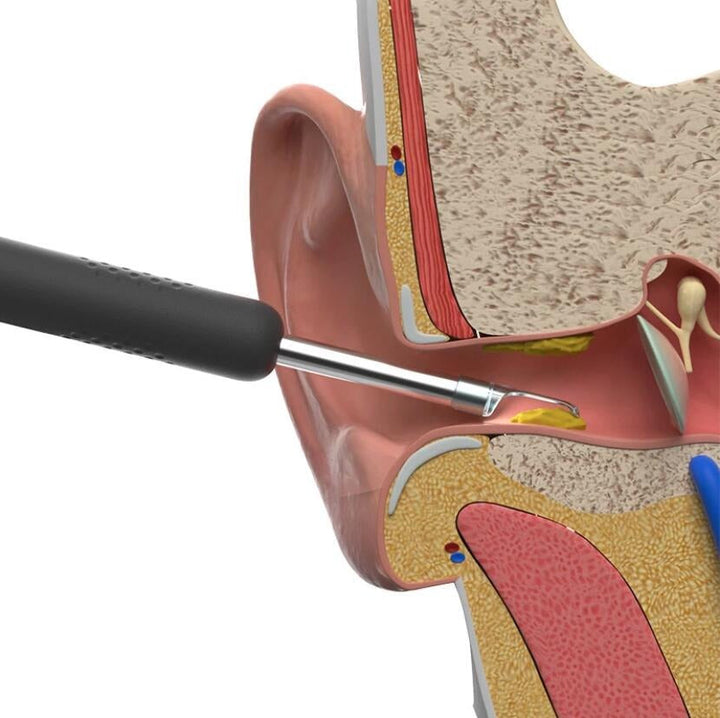 Intelligent Earwax Removal Otoscope - FOFOPO