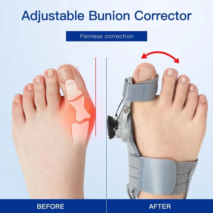 Bunion Fix – Natural At-Home Bunion Relief - FOFOPO