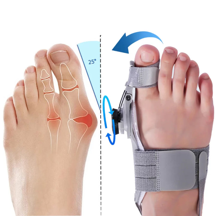 Bunion Fix – Natural At-Home Bunion Relief - FOFOPO