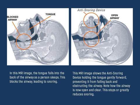 Apnea Tongue Stabilizing Device - FOFOPO