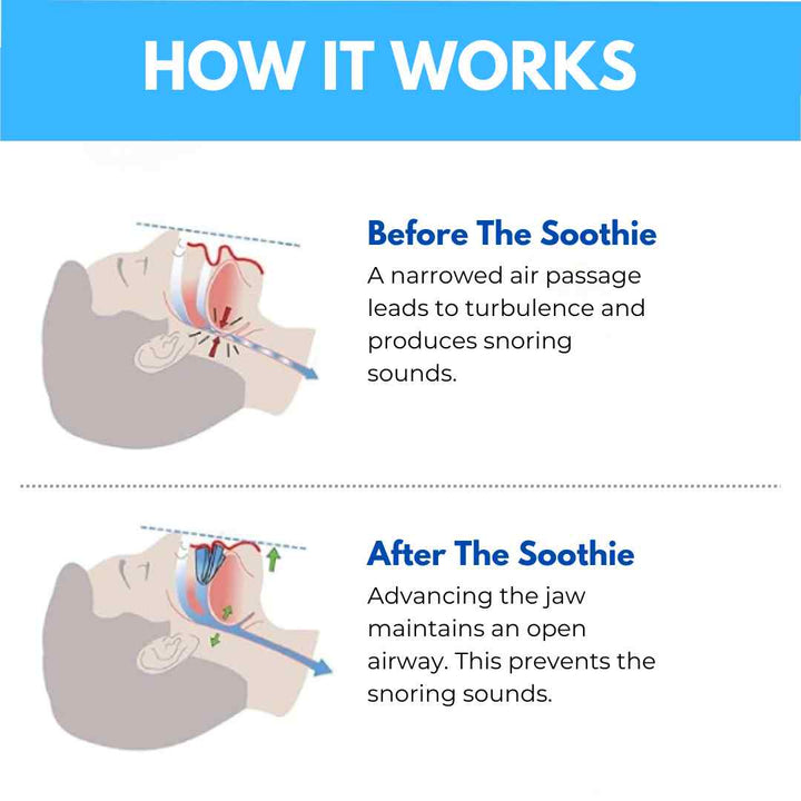 THE SOOTHIE ANTI SNORING MOUTHPIECE - FOFOPO